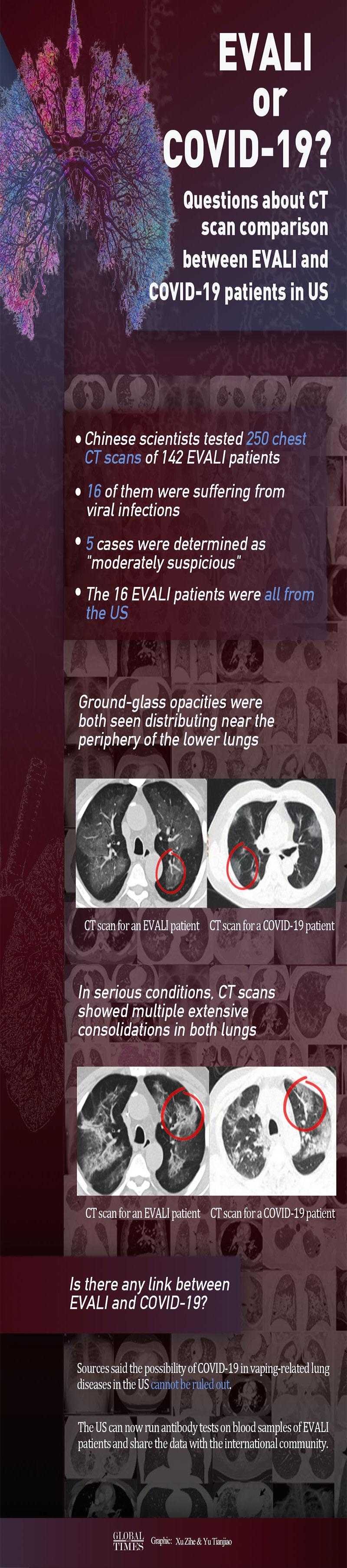 EVALI and COVID-19, CT Scan,